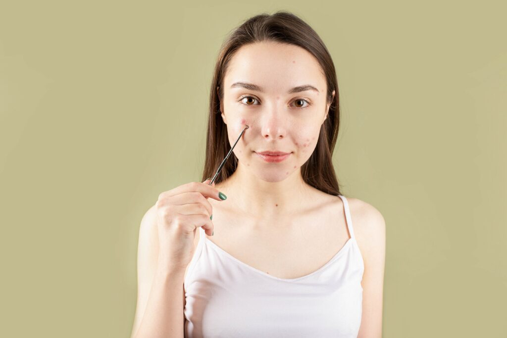 A female pointing at her acne skin - how to repair the skin barrier.