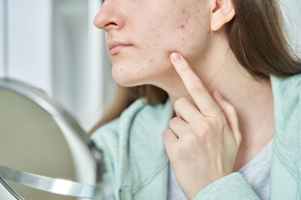 6 Powerful Rosacea Skincare Routine